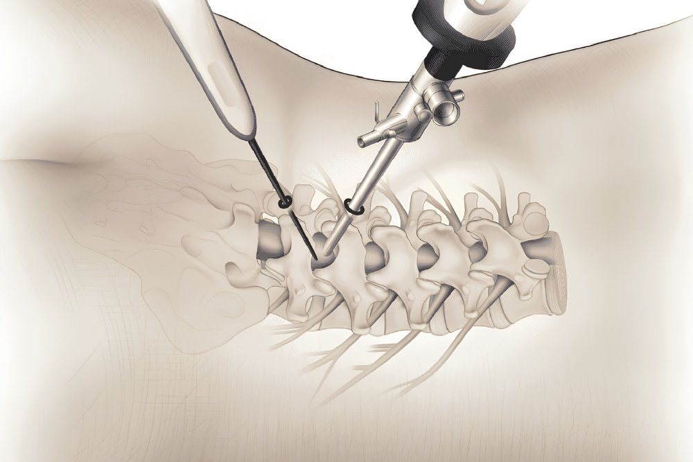 Spine Surgery