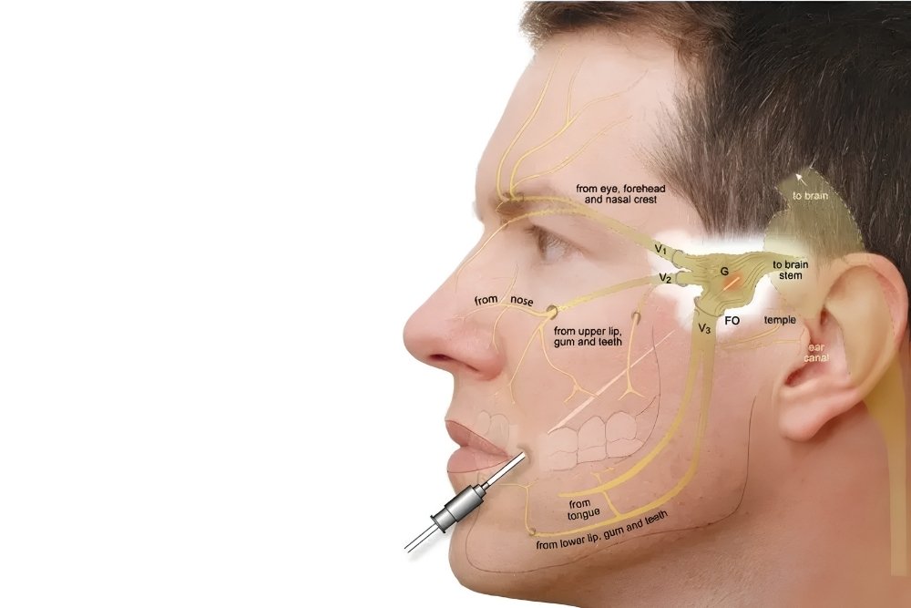 Trigeminal Pain Ablation